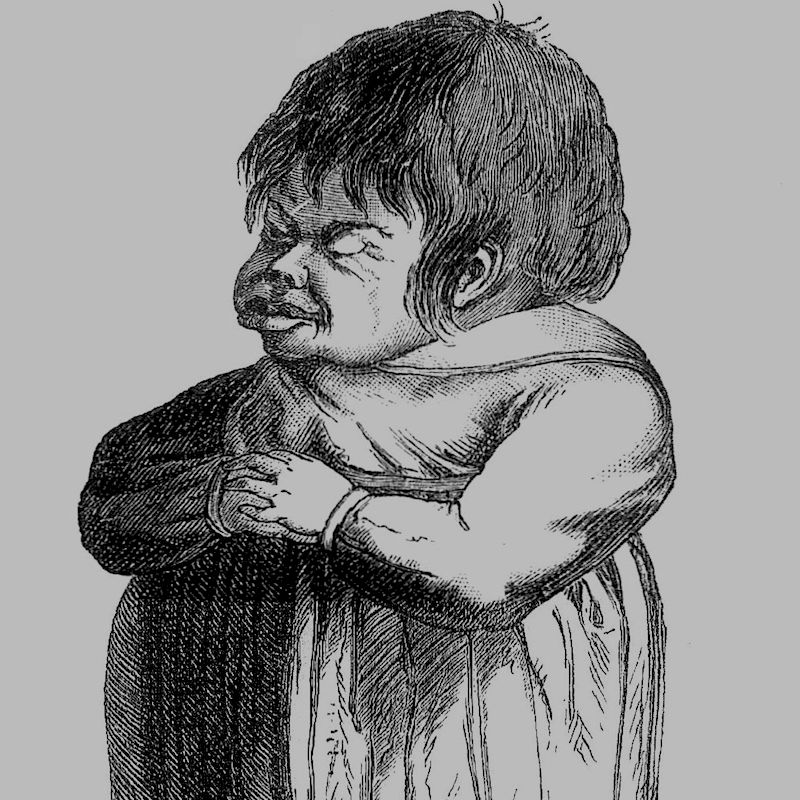 Kretinismus (aus Meyers Großes Konversations-Lexikon. 6. Aufl.)